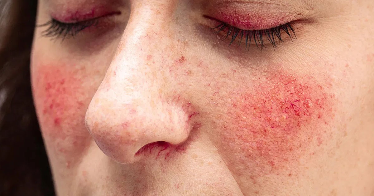 Rosacea